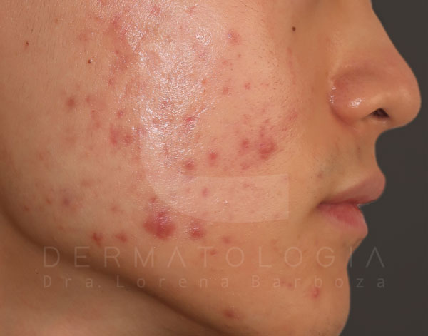 cicatrices-rojas-y-acne-activo-dermatologa-lorena-barboza