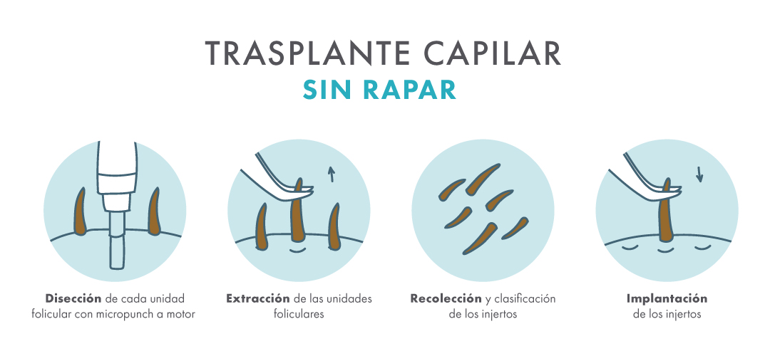 web_dermalorena_infografia_trasplantecapilar Trasplante capilar, infografía, pasos del proceso