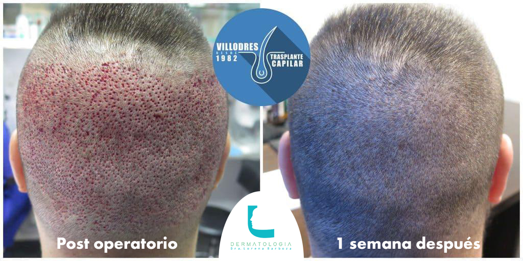 antesydespues_trasplante_capilar_dermalorena_02 Antes y después de postoperatorio de trasplante capilar