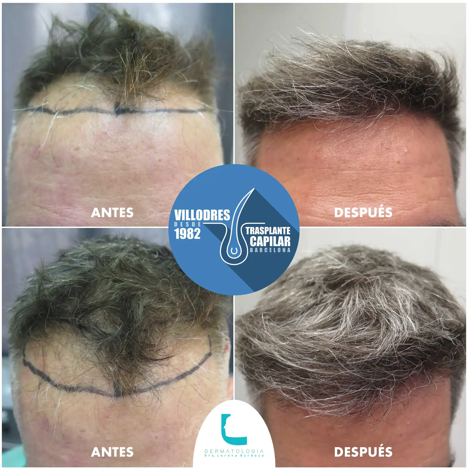 antesdespues_trasplantecapilar_dermalorena_4 Caso de antes y después trasplante capilar